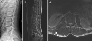 (A–C) A 35-year-old man with atypical spinal TB. (A) Lateral lumbar spine radiograph showed tumefaction of paravertebral soft tissue. (B) A sagittal T2-weighted MRI showed worm-eaten destruction of vertebral endplate at multiple vertebral bodies (T11-L1), irregular abnormal signal in paravertebral soft tissue. (C) Axial MRI showed formation of fistula at level of L2 vertebral body.