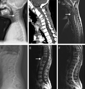 (A–C) A 5-year-old children with atypical spinal TB. (A) Lateral cervical vertebra radiograph showed bone destruction and osteopenia of the C4 vertebral body. (B) CT scan showed irregular lesions at the C4 vertebral body and swelling in paravertebral soft tissues. (C) C4 vertebral body had high signal on the T2-weighted image and the involved vertebral body was osteolysis or wedging. (D–F) A 60-year-old woman with atypical spinal TB. (D) Lateral lumbar spine radiograph showed T11 was slightly wedging. (E), (F) MRI showed an isolated slightly concentric collapse of the T11 vertebral body. The adjoining disk spaces were preserved.