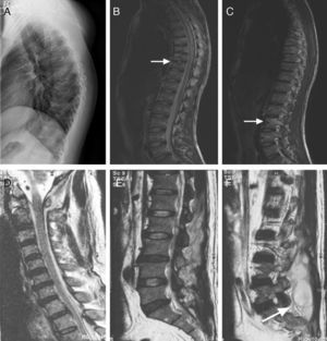 (A–C) A 21-year-old man with atypical spinal TB. (A) Lateral thoracic vertebra radiograph showed irregular lesions at the T7–10 vertebral body. (B), (C) MRI showed slight lesions at the upper and lower edges of T7–10 vertebral body. L3 vertebral body accessories had high signal on T2-weighted images. (D–F) A 45-year-old man with atypical spinal TB. (D) MRI showed multiple abscesses in extradural intraspinal canal at C1-T3 without identifiable osseous lesion. (E), (F) MRI showed multiple paravertebral abscesses at L1-S2 without identifiable osseous lesion.