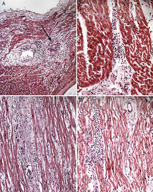 (A) Chronic inflammatory infiltrates with lymphocytic and eosinophilic predominance. There is an area of myocyte necrosis and mild interstitial scarring (arrow), (B) diffuse myocardial inflammatory infiltrates, mainly lymphocytes and scattered giant cells, (C) perivascular inflammation with associated endocardial fibrosis. There is myocyte necrosis and endothelial hyperplasia and (D) focal lymphocytic myocarditis. This focus and other foci were the only relevant findings in this case, raising the question of focal myocarditis as the cause of sudden death.
