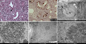 Polyomavirus infection in graft transplant morphology. (A) Epithelial tubular nuclear inclusion (arrow) by H&E; (B) SV40 nuclear staining (brown) by immunohistochemistry; (C and D) viruses aggregates in rough endoplasmastic reticulum (arrowhead) close to nucleus (N) by TEM; (E and F) Viral particles organized as crystalline arrays in nucleus by TEM.