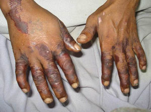Purpuric rash on hands.