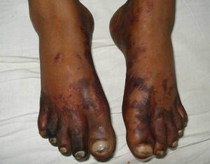 Skin rash and gangrenous changes in lower limb.