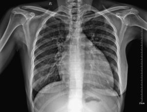 Chest radiography showed an enlarged and globular cardiac silhouette and pulmonary congestion without pleural effusion.