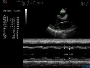 Echocardiography showed decreased left ventricular systolic function, including descending ejection fraction and fractional shortening.