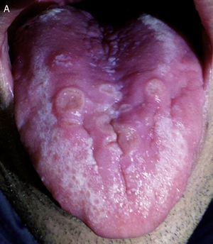 Asymptomatic ulcerated lesions in the tongue.