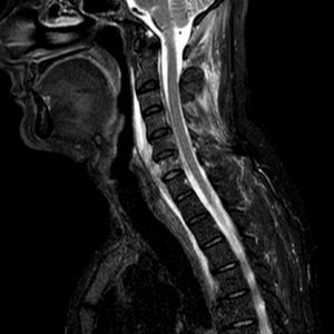 MRI sagittal slide of the cervical spine (STIR sequence) showing spondylitis of the sixth cervical vertebra with prevertebral abscess and infiltration of the neighboring soft tissues and muscular compartment in a 52-year-old immunocompetent man.