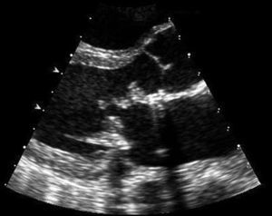 Echocardiogram showing vegetations on the prosthetic mitral valve with mild obstruction to mitral inflow.