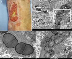 Bacterial biofilm in chronic venous ulcer. (A) Venous leg ulcer of a 33-year-old woman with a history of deep vein thrombosis in the left leg and pulmonary embolism. This wound was present in left medial malleolus for two years, showing 15.37cm2 and 40% of yellow necrotic tissue. (B) Bacterial colonies showing spherical and rod-shaped cells seen by transmission electron microscopy. (C and D) Bacteria surrounded by a dense extracellular matrix.
