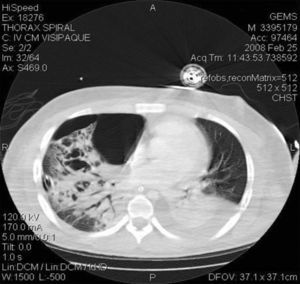 C/T scan of the chest showing right pneumothorax as well as bilateral consolidations and characteristic bullae.