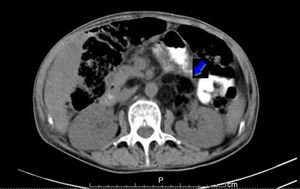 CT scan showing retroperitoneal tumour to the left, with irregular, infiltrative aspect, predominantly of fat content, highlighted by the contrast, as shown by the arrow.