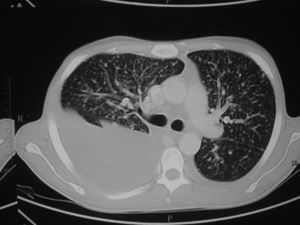 Massive pleural effusion in the right hemithorax, diffuse bilateral micronodular infiltration in both lungs, and hilar lymphadenopathy in thoracic CT.
