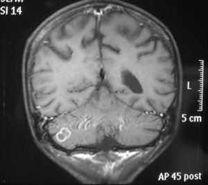Lesion on the right cerebellar hemisphere of approximately 1cm, which was hypointense in T1 and hyperintense in T2 weighted images in cranial MRI.