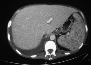Hypodense nodular lesions in the liver and spleen, and mesenchymal multiple lymphadenopathy in the abdominal CT.