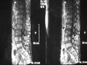 Multiple nodular lesions (tuberculomas) in the vertebral corpus in spinal MRI.