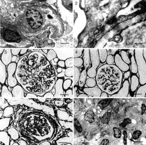 Kidney: glomerulonephritis pattern in dogs with naturally acquired VL. Histopathology (light microscopy) and ultrastructure. (1) Minor glomerular abnormalities. Glomerular, visceral, and epithelial cell vacuolization and protein droplets in the cytoplasm of the podocytes (arrow). Foot process effacement (arrowhead) can be seen. EM. Bar=500μm; (2) focal, segmental glomerulosclerosis. Swelling and effacement of visceral and epithelial cell foot processes. Absence of electron-dense particles from the glomerular capillary basement membrane. EM. Bar=2170μm; (3) diffuse, membranoproliferative glomerulonephritis. Segmental thickening and duplication of the peripheral glomerular capillary wall. PAMS. Bar=25μm; (4) diffuse, mesangial proliferative glomerulonephritis. Normal glomerular capillary wall. PAMS. Bar=25μm; (5) crescentic glomerulonephritis. Fibrocellular or fibrous proliferation occupying part of the Bowman's space. PAMS. Bar=25μm; and (6) chronic glomerulonephritis. Intense activity of fibroblasts, collagen proliferation, and cell remnants in interstitial space. Bar=350μm.