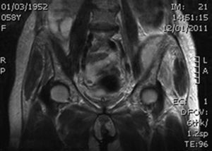 Magnetic resonance imaging of the abscess (T2-weighted, coronal section).