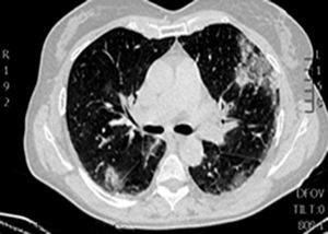 Computed tomography of the thorax showing bilateral lung infiltrates.