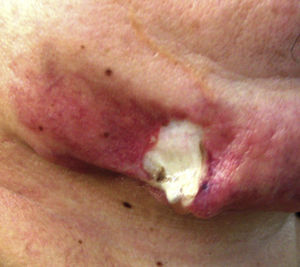 The ulcerative lesion on the patient's chin.
