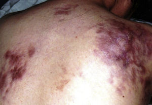 The scars of the healed lesions on the dorso-thorocal region of the body.