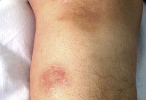The cutaneous nodule on the lower extremity.