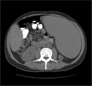 CT abdomen at admission.