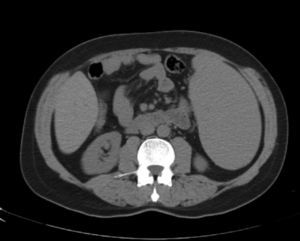 CT abdomen nine months after chloroquine use.