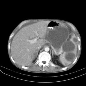 Multiple cystic lesions in spleen.