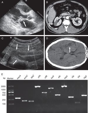 Infective endocarditis complicating systemic embolism (the arrows indicate areas of interest) and detection of key genes. (A) Color Doppler echocardiography showing the vegetation attached to the anterior mitral valve leaflet. (B) Spiral computed tomography showing renal infarction. (C) Echocardiographic examination showing embolization of the right common iliac artery and right internal and external iliac arteries. (D) Computed tomography of the brain showing multiple low-density lesions. (E). Detection of antimicrobial genes, virulence-related genes and adhesion genes by PCR amplification. Lane 1, molecular weight marker; lane 2, mecA; lane 3, ermC; lane 4, blaZ; lane 5, clfA; lane 6, clfB; lane 7, icaA; lane 8, efb; lane 9, fnbA; lane 10, hlb; lane 11, hld; lane 12, hlg2.