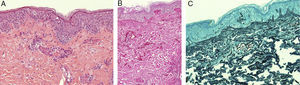 Skin biopsy showing abundant septate hyphae structures. (A) 200× hematoxylin–eosin stain revealing basophilic yeast and hyphae structures in superficial dermis and perivascular sites, with minimal inflammatory component. (B) Skin biopsy in 100× Periodic acid-Schiff stain, revealing fungal cell walls in magenta. (C) 200× Grocott's methenamine silver stain, revealing intravascular and epidermal fungal structures, stained in black.