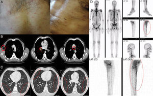 (A) Non-confluent maculo-papular rash in the trunk. (B) Contrast-enhanced CT scan showing multiple axillary, hilar and mediastinal lymphadenopathy. (C) Contrast-enhanced CT scan showing bilateral and diffusely distributed pulmonary nodules with ground-glass density. (D) Bone scintigraphy showing increased uptake on the right tibia.