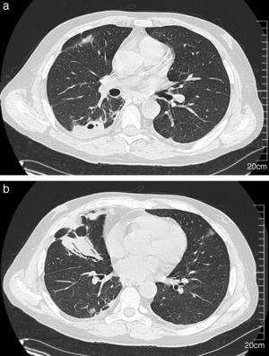 Chest CT scan showing right-sided multiple pulmonary nodules with cavitation (A) and parenchymal consolidation in the middle lobe (B).