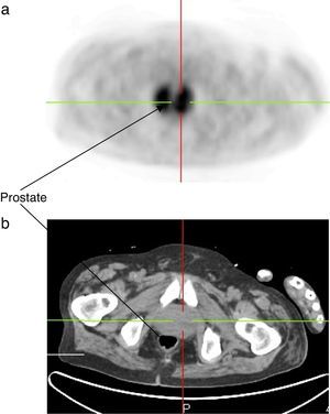 PET scan showing an intense and diffuse accumulation of the FDG in the prostate (A: PET imaging; B: scanned imaging of the prostate).