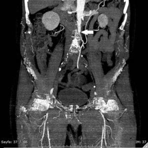 In the coronal section of the intravenous contrast-enhanced abdominal CT; initial localization of the infrarenal occlusion in the abdominal aorta (arrow).