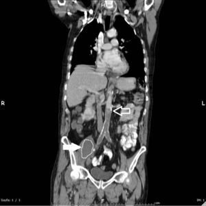 In the coronal section of the oral and intravenous contrast-enhanced abdominal CT; initial localization of the infrarenal occlusion in the abdominal aorta (hollowarrow), a hypodense heterogeneous abscess leading to expansion of right psoas muscle (arrow).