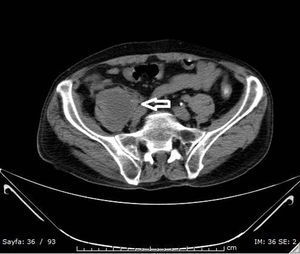 In the axial non-contrast abdominal CT; formation of a hypodense heterogeneous abscess leading to expansion of right psoas muscle which is accompanied by increased densities in the neighboring fatty tissue (hollowarrow).