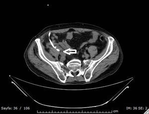 In the non-contrast axial section of the abdominal CT; drainage catheter extending to abscess area in the right psoas muscle (hollowarrow).