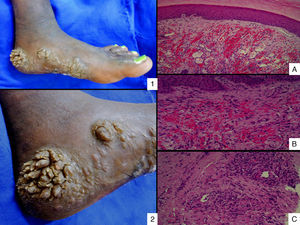 (1) Hyperkeratotic KS on the medial side and plantar region of the left foot. (2) Hyperkeratotic KS (in more detail). Epidermis with hyperkeratosis (A) and dermis with proliferation of mesenchymal lineage cells and malformed vessels with the presence of red blood cells out of the light thereof (B and C).