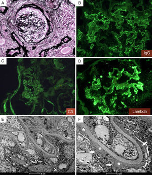 Membranous glomerulonephritis secondary to syphilis. (A) Glomerulus with a thick Bowman's capsule and interstitial fibrosis by Jones’ Methenamine Silver Stain. Immunofluorescence showing positive staining in glomerular basal membrane for IgG (B), C3 (C) and lambda (D); (E) and (F). Transmission electron microscopy showing extensive diffuse foot process (arrow) and subepithelial electron dense deposits (asterisk).