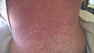 Maculopapular generalized rash on patient