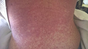 Maculopapular generalized rash on patient's back.