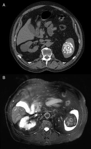 CT and MRI findings in a case of isolated chronic splenic brucelloma. Unenhanced CT (A) and fat-suppressed T2-weighted MR (B) images demonstrate multiple, thinly, target-like, concentrically lamellated calcifications in the spleen, a pattern considered characteristic for this diagnosis.