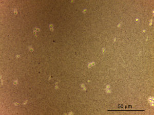 Budding encapsulated spherical and ellipsoidal yeast cells of Cryptococcus laurentii from blood specimen at direct examination and contrasted with India ink.
