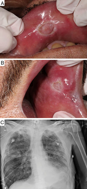 Clinical aspects of oral TB lesions and lung radiographic findings. Ulcerative lesions with granulomatous center and whitish halo on the upper labial mucosa near the median line (A) and on the left jugal mucosa, near the labial posterior commissure (B). Full radiograph of the lower left pulmonary lobe. Presence of active disease manifested as budding tree-like centrilobular nodules in both lungs, especially on the right (C).