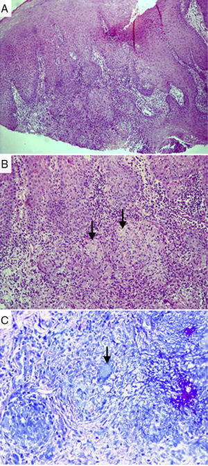 Histopathological analysis of a sample collected from oral TB lesions. Granulomas surrounded by intense mixed inflammatory infiltrate, with inflammatory cells inside the epithelium. Hematoxylin–eosin staining, 100× magnification (A). Well-shaped granulomas surrounded by epithelioid histiocytes and inflammatory cells. Arrows indicate incipient necrosis. Hematoxylin–eosin staining, 200× magnification (B). Arrow indicates giant Langhans cell, with nuclei distributed across the peripheral cytoplasm, in a necklace pattern. Langhans cells are typical of TB. Ziehl–Neelsen staining, 600× magnification (C).