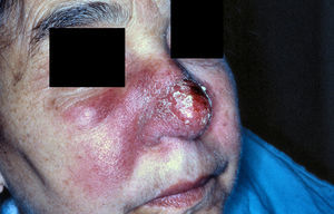 Erythematous-edematous-infiltrative plaque involving mainly the right side of the centro-facial region.
