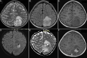 Axial T2-weighted (A) and FLAIR images (B) revealing hyperintense cortical-subcortical 50mm×40mm lesion with surrounding edema. Axial T1-weighted (C), diffusion-weighted (DWI) (D), apparent-diffusion coefficient (E) and T1-weighted post-contrast images with peripheral ring-like enhancement (F) confirming abscess formation.