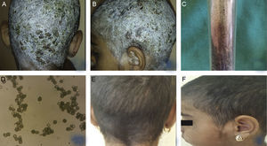 (A, B) Clinical presentation of TC, caused by Aspergillus niger in a 9-year-old female patient – diffuse white desquamation with multiple yellowish crusts with areas with yellow exudation, single follicular papules, and disseminated exudative vesicles, without hair loss. (C, D) Growth of Aspergillus niger established on mycological examination on Sabouraud agar and direct microscopic evaluation. (E, F) Clinical presentation within the regimen with Terbinafine, dosage 125mg per day, after antibiotic and keratolytic therapy.
