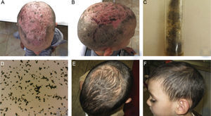 (A, B) Clinical presentation of TC, caused by Aspergillus niger in a 4-year-old male patient – hair loss and diffuse desquamation with multiple yellowish and brownish crusts at the area of the vertex, with severe erythema of the underlying skin and hemorrhagic crusts. (C, D) Growth of Aspergillus niger established on mycological examination on Sabouraud agar and direct microscopic evaluation. (E, F) Clinical presentation on the 90th day within the regimen with oral administration of Terbinafine – dosage 75mg per day. Good therapeutic response was observed on 30th day, as hair growth and single areas of effluvium was still observed on the 90th day.