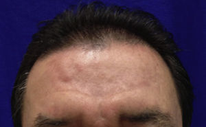 The disappearance of tubero-serpiginous syphilids on forehead after the end of treatment.
